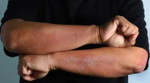 sering disangka ruam biasa, ini 5 gejala psoriasis yang perlu dikenali