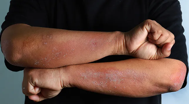 Sering Disangka Ruam Biasa, Ini 5 Gejala Psoriasis yang Perlu Dikenali